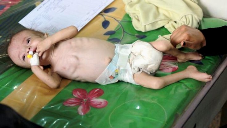 Orjowan, akut yetersiz beslenme çeken yaklaşık yarım milyon Yemenli çocuktan biri